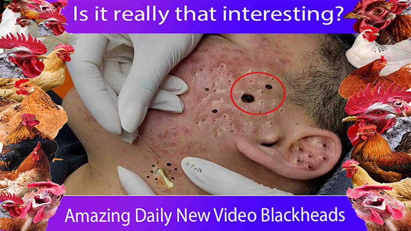 Blackheads Removal!